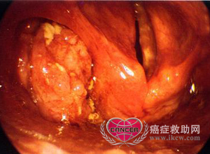 首页 癌症专题 >> 基础