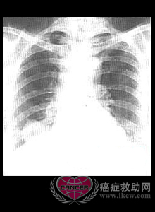 肺类癌和支气管类癌检查