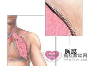胸膜间皮瘤的表现